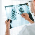 U Srbiji 410 slučajeva tuberkuloze: Deca sve ređe obolevaju, muškarci i stariji najviše pogođeni