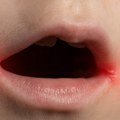 Kako prepoznati impetigo osip, plikove, lezije: Veoma zarazna infekcija koja ne miruje leti širi se Jadranom, prenosi se…