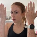 Девојку изуједале стенице у познатом хотелу: Објавила фотографије тела, изгледају језиво