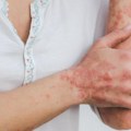 U Srbiji 140.000 obolelih od psorijaze: Razgovor sa dermatologom prvi korak