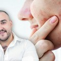 Akne kod odraslih nisu znak loše higijene: Dr Lukić objašnjava zašto se bubuljice javljaju, greške u nezi i kako sprečiti…