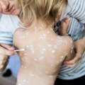 Izbila epidemija malih boginja u severnom Londonu, zaraženo više od 60 dece