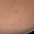 Majka papreno platila apartman, a dete joj se probudilo sa ujedima "Ima 30 uboda po telu! Mislili smo da su komarci, ali su u…