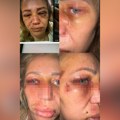 Prijateljica Darka Lazića brutalno pretučena, oglasila se pevačica o užasnom nasilju koje se desilo: "Reagujte dok još nije…