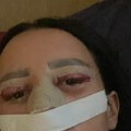 "Pijem tablete za smirenje, ovo mi utiče na psihu": Zadrugarka se oglasila nakon operacija: Htela da promeni lični opis, sad…