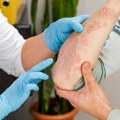 Sunce i muke s psorijazom: Spas u biološkoj terapiji
