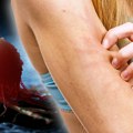 Kada svrab kože ukazuje na rak: Onkolog otkriva 5 ključnih karakteristika