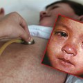 Prvi slučaj malih boginja registrovan u Srbiji! Obolelo nevakcinisano dete! Ono na šta su naši lekari sa zebnjom…