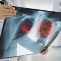 Od ove bolesti u Srbiji svake godine umre 5.000 ljudi: Jedna stvar može da bude presudna
