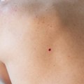 Imate ovakve crvene tačkice po koži: Ovo su razlozi zašto se pojavljuju, a evo kada da se javite lekaru