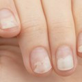 Oniholiza - pojava na noktima koja ukazuje na bolesnu štitnu žlezdu, psorijazu, slab imunitet, nedostatak vitamina... Kako…