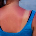 Izgoreli ste na suncu? Dermatolozi otkrivaju šta odmah treba da uradite