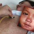 Proglašena epidemija morbila u Novom Pazaru: Bolest potvrđena i kod trećeg deteta, nije porodično povezano sa drugom…