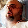 "Oko je visilo iz duplje": Medved mu otkinuo levu stranu lica zamahom šape i žvakao glavu poput psa koji glođe kost