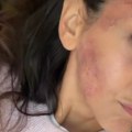 Ivani Dudić lice u podlivima i ogrebotinama: Glumica doživela nezgodu, otkrila šta joj se desilo (foto)