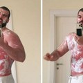 "Не знам ког су степена опекотине!" Адактар показао тело и открио кроз шта пролази: Теже ми је него вама…