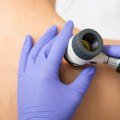 Veliki broj sumnjivih promena na koži otkriven na KiM: Pregledano više od 800 građana u toku velike preventivne trodnevne…