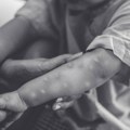 Epidemija majmunskih boginja zahvatila celu Sijera Leone: Više od 3.000 zaraženih, 14 preminulih