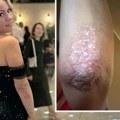 Marija (41) iz Beograda je iznenada dobila ovu bolest, prvo se pojavilo na laktu, a onda...! Ovo su simptomi