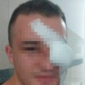 (FOTO) Ovo je radnik obezbjeđenja koji je brutalno pretučen u Novom Pazaru: Čeka operaciju sa brojnim prelomima, nasilniku…