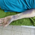 Vrućine povećavaju rizik od tromboze: Doktor otkriva ko je najugroženiji i kako da se zaštitite VIDEO