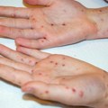 Paradoks vakcinacije: Zašto pada stopa imunizacije?