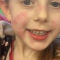 Lili (5) nije mogla da hoda i bila je osuta "od glave do pete": Ujela je lažna udovica, evo kako izgleda