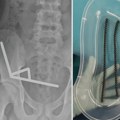 Dečak (13) hospitalizovan nakon što je progutao desetine neodijumskih magneta - odstranjen mu deo creva