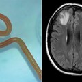 Ženi u mozgu lekari pronašli živog crva od osam centimetara
