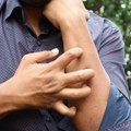 Nije u pitanju “slatka krv”: Komarci biraju baš vas zbog ova četiri razloga
