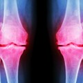 Osteoartritis: Optimističke prognoze za nove tretmane lečenja