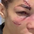 Uznemirujuće! Evo kako izgleda Sofija Montenegro posle jezivih batina u Parizu, lice joj potpuno unakaženo!