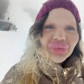 Andrea ima najveće usne na svetu: Zbog njih ima problem sa disanjem, stomatolozi odbijaju da joj leče zube, ali ona ne planira…
