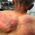 Prebijeni Srbin prevezen u Urgentni centar u Beogradu! Kosovska policija vezala Nenada Raškovića za drvo i brutalno ga tukla…