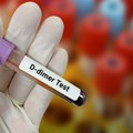 D-dimer test: Šta znači povišen nalaz i kada je vreme za brigu?