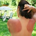 Dermatolog izneo niz saveta šta raditi ako ste jako izgoreli na suncu: Ove greške mnogi prave