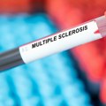 U Srbiji oko 9.000 ljudi boluje od multiple skleroze: Jedna stvar je ključna
