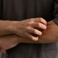 Strah od virusa Zapadnog Nila: Sada smo oprezniji i na ubod komarca