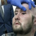 Strujni udar mu uništio veći deo lica! Medicinsko čudo u Americi: Veteranu urađena prva uspešna transplantacija oka…