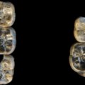 Nekoliko zuba pronađenih u Etiopiji možda otkriva ključne nedoumice evolucije ljudi