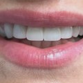 Dental Studio Aleksandar: Cirkonijumske krunice, prirodan osmeh koji traje