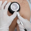 Zašto je Srbija u vrhu Evrope po smrtnosti od melanoma?