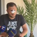 Srbinu polomljen nos, kaže da je sa komšijom Albancem imao problem oko povrća