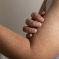 Navike pod tušem i odeća čine "guščju kožu" još grubljom: Dermatolog otkriva koje kreme jedino pomažu