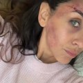 Ivana Dudić sva modra i izgrebana: Glumica doživela nezgodu, otkrila šta joj se dogodilo (foto)