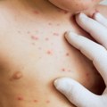 Virus opet zabrinjava: Kako da prepoznate male boginje?