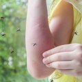 Šta zaista ublažava svrab, bol i otok zbog uboda komarca, otkriva lekar
