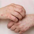 Bugarska: potvrđeno više od 500 slučajeva zaraženih morbilama