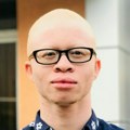 Svetla koža, a crna sudbina: Kako je praznoverje pretvorilo albino crnce u plen bogataša