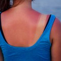 "Preterano izlaganje suncu dovodi do oštećenja i karcinoma": Dermatolog upozorava da na jednu stvar